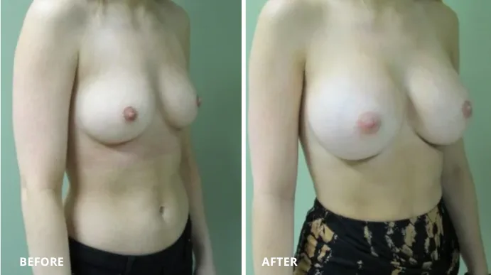 Breast augmentation before and after comparison, side angle view