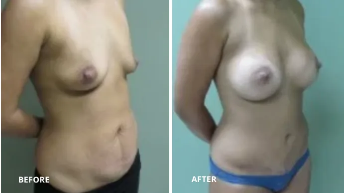Before and after breast augmentation, patient shown from side view