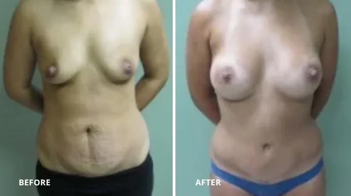 Breast augmentation before and after comparison, frontal view