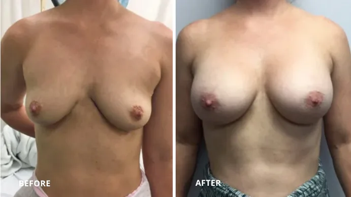 Before and after breast augmentation, patient shown from front view