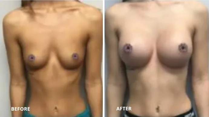 Before and after breast augmentation, patient shown from front view
