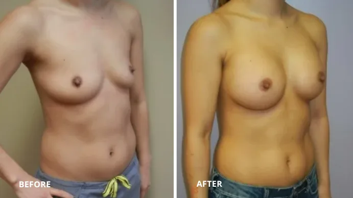 Before and after breast augmentation, patient shown from front angle