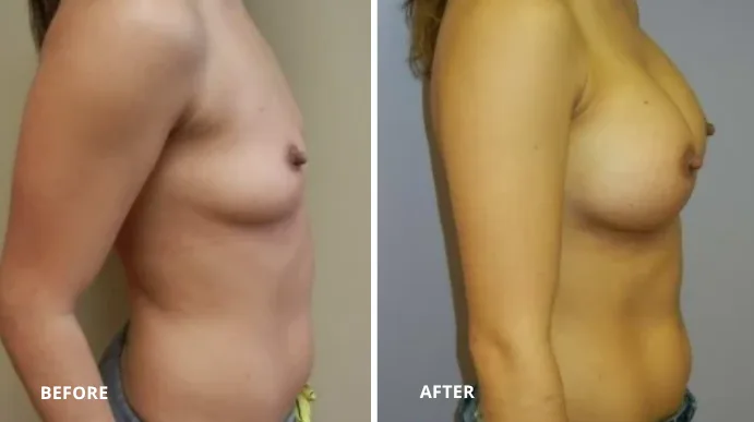 Before and after breast augmentation, patient shown from side profile
