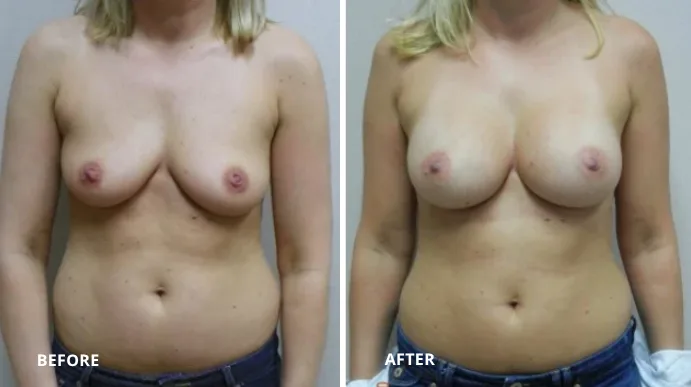 Before and after breast augmentation, frontal view
