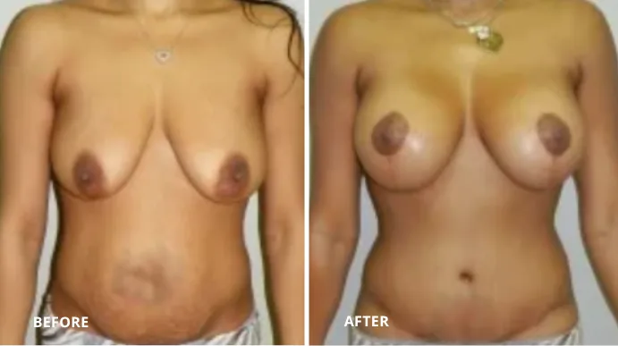 Before and after breast augmentation, frontal view