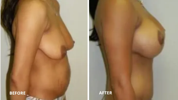 Before and after breast augmentation, side profile view
