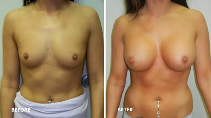 Breast augmentation before and after, front view showing enhanced breast size and shape