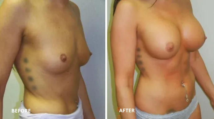 Before and after breast augmentation, side view