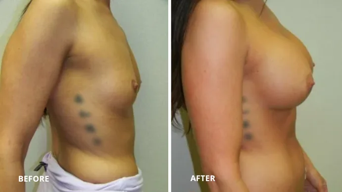 Breast augmentation before and after, side view showing increased volume and projection
