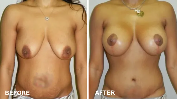 Breast lift before and after front view showing improved breast elevation and shape