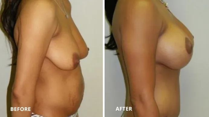 Breast lift before and after side profile showing elevated breast position and contour