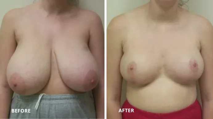 Breast reduction before and after, front view showing reduced volume and lifted contour