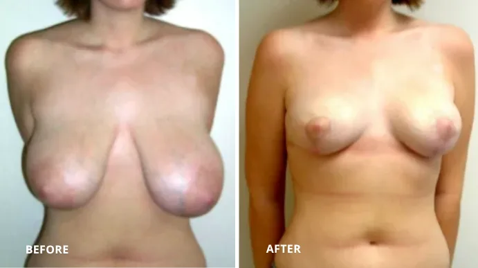 Breast reduction before and after, front view showing smaller, lifted breasts with improved proportions