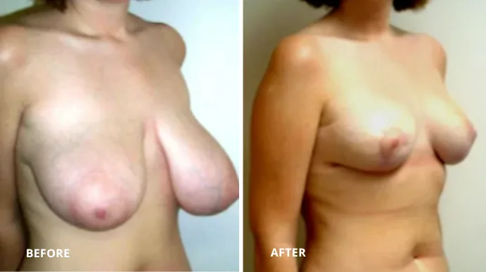 Breast reduction before and after, side view showing decreased size and improved positioning