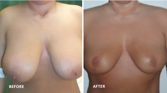 Breast reduction before and after comparison showing reduced breast volume and improved contour