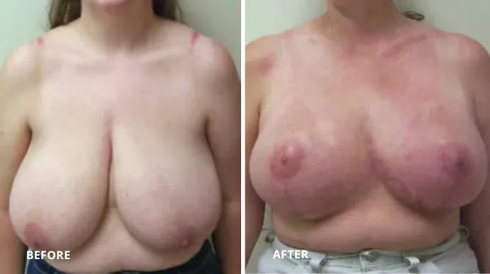 Breast reduction before and after showing decreased breast size and lifted position