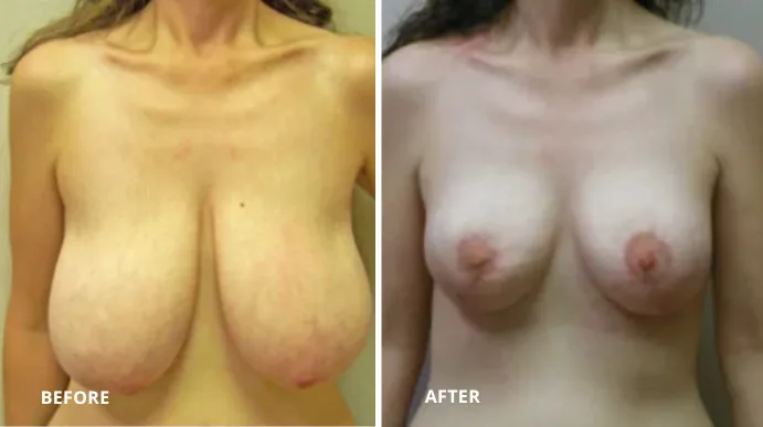 Breast reduction before and after displaying significant volume reduction and improved shape