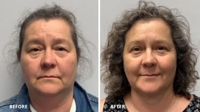 Before and after eyelid lift, frontal view showing reduced eyelid drooping and improved eye opening