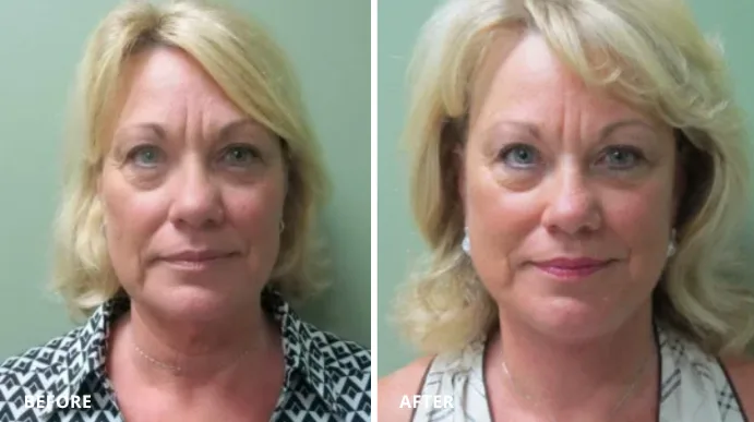 Before and after facelift, frontal view showing reduced facial sagging and improved skin texture