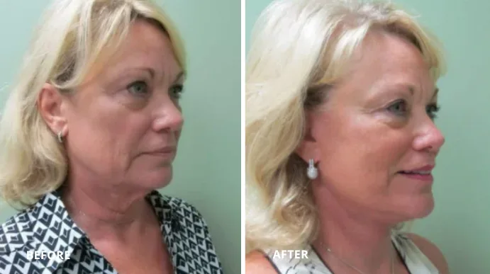 Before and after facelift, side profile view showing enhanced facial contours and lifted appearance