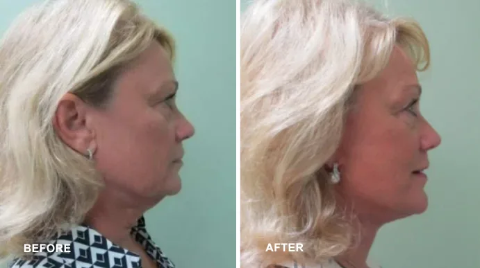 Before and after facelift, side profile view showing improved jawline definition and skin tightness