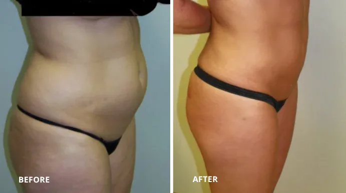 Before and after liposuction case showing abdominal contouring results