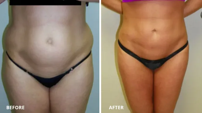 Before and after liposuction, frontal torso view showing reduced abdominal fullness and defined midsection
