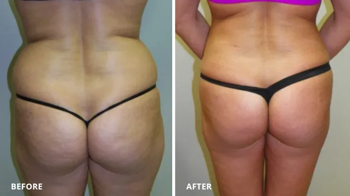 Before and after liposuction, rear torso view showing improved body contours and reduced waist fullness