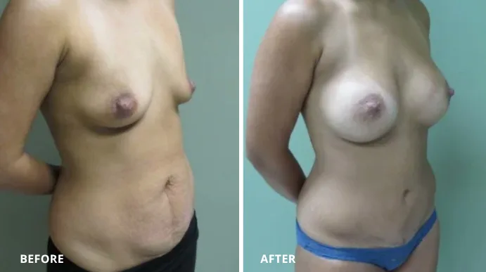 Before and after mommy makeover case showing breast augmentation and body contouring from side view