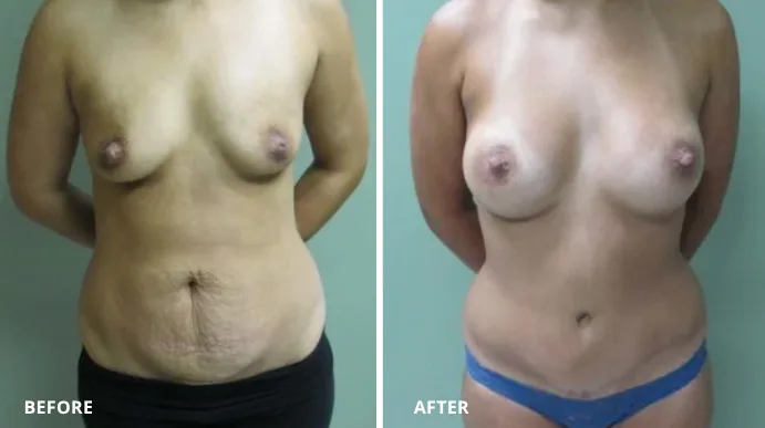 Before and after mommy makeover case showing breast augmentation and abdominal contouring