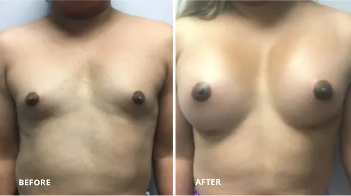 Before and after MTF breast augmentation case showing front view results