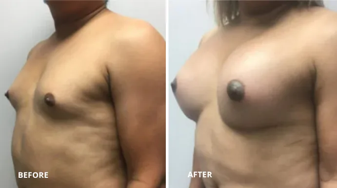 Before and after MTF breast augmentation case showing side view results