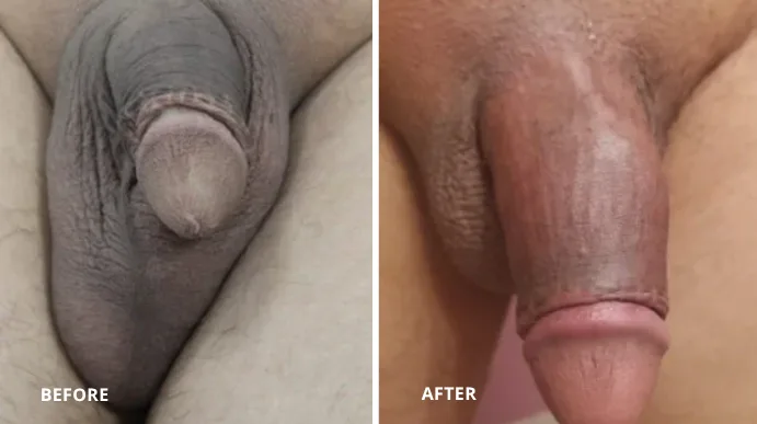 Before and after penis girth enhancement showing increased girth and improved appearance