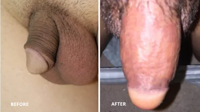 Before and after penis girth enhancement case