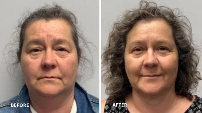 Before and after submental liposuction showing reduced under-chin fullness and improved facial contour