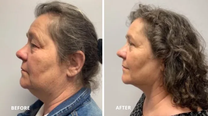Before and after submental liposuction showing reduced under-chin fullness and improved jawline definition