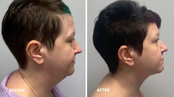 Before and after submental liposuction showing reduced submental fat and more defined neck profile