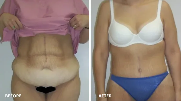 Tummy tuck before and after, frontal view showing abdominal skin removal and contouring