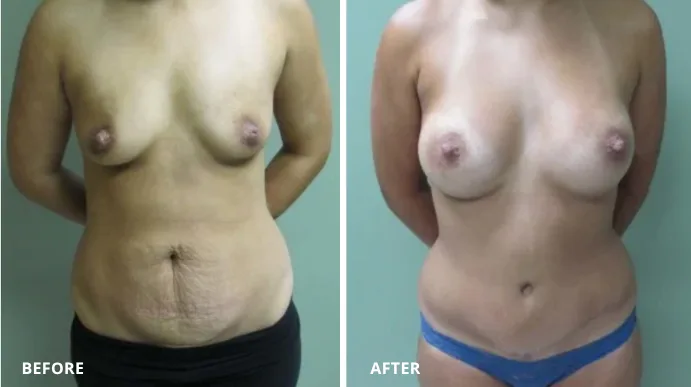 Tummy tuck before and after, frontal view showing abdominal flattening and contouring