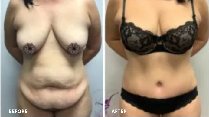 Tummy tuck before and after, frontal view showing abdominal and torso contouring