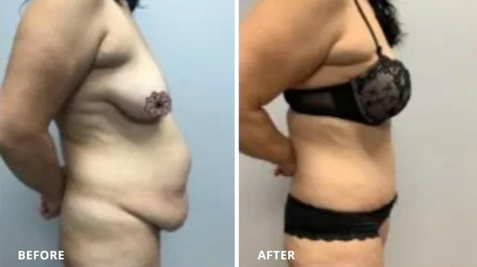 Tummy tuck before and after, side view showing abdominal profile improvement