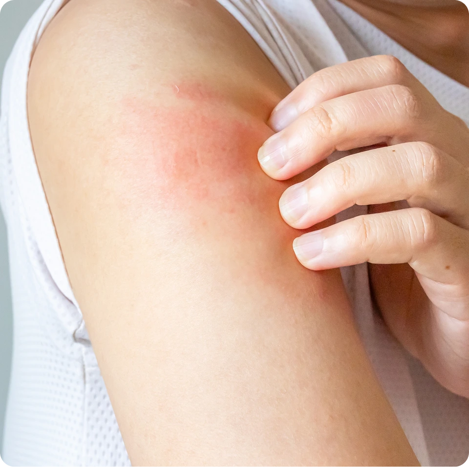 Person's arm showing red rash or skin irritation with hand touching affected area