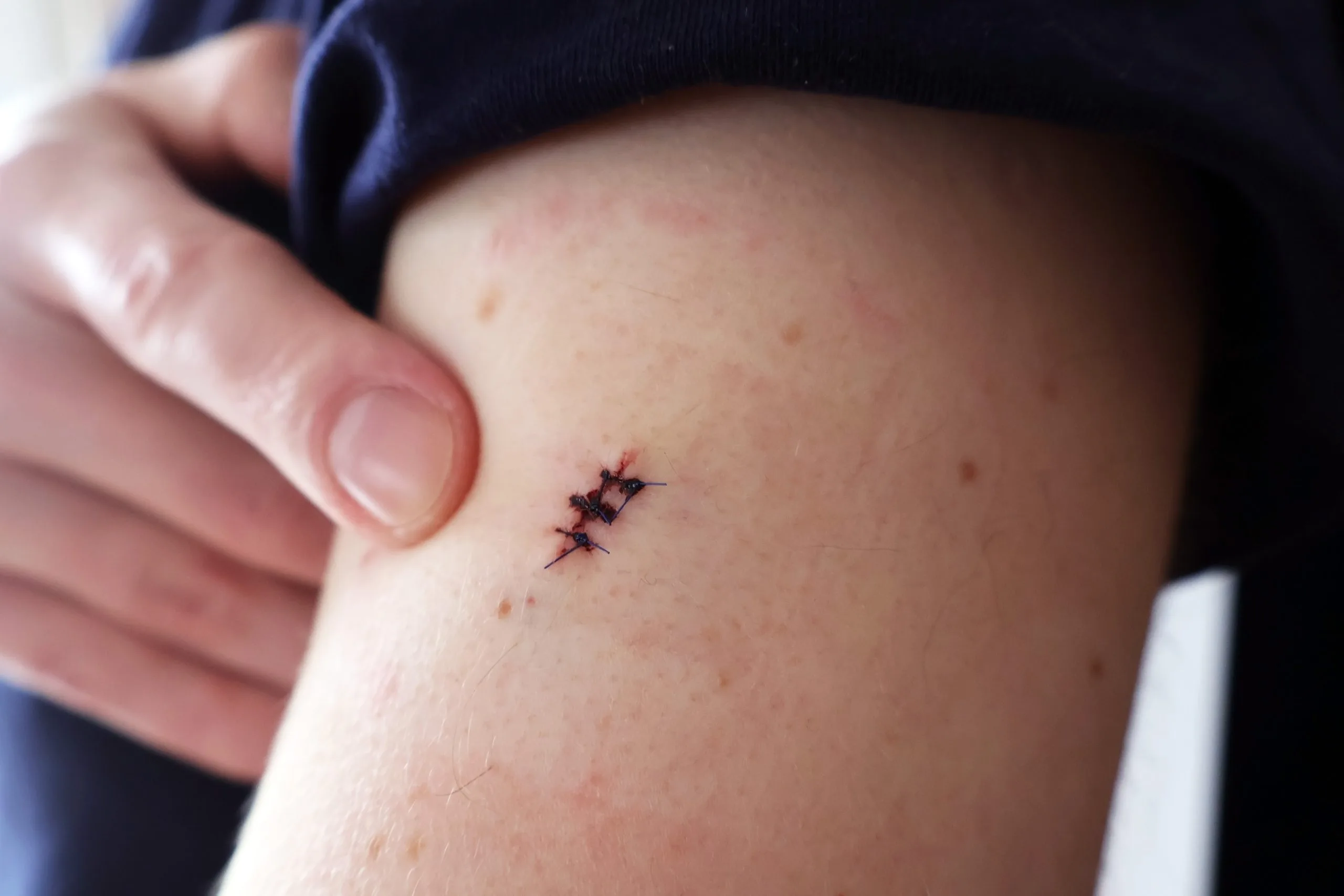 Forearm with a small surgical wound closed with dark stitches in the post-operative healing stage