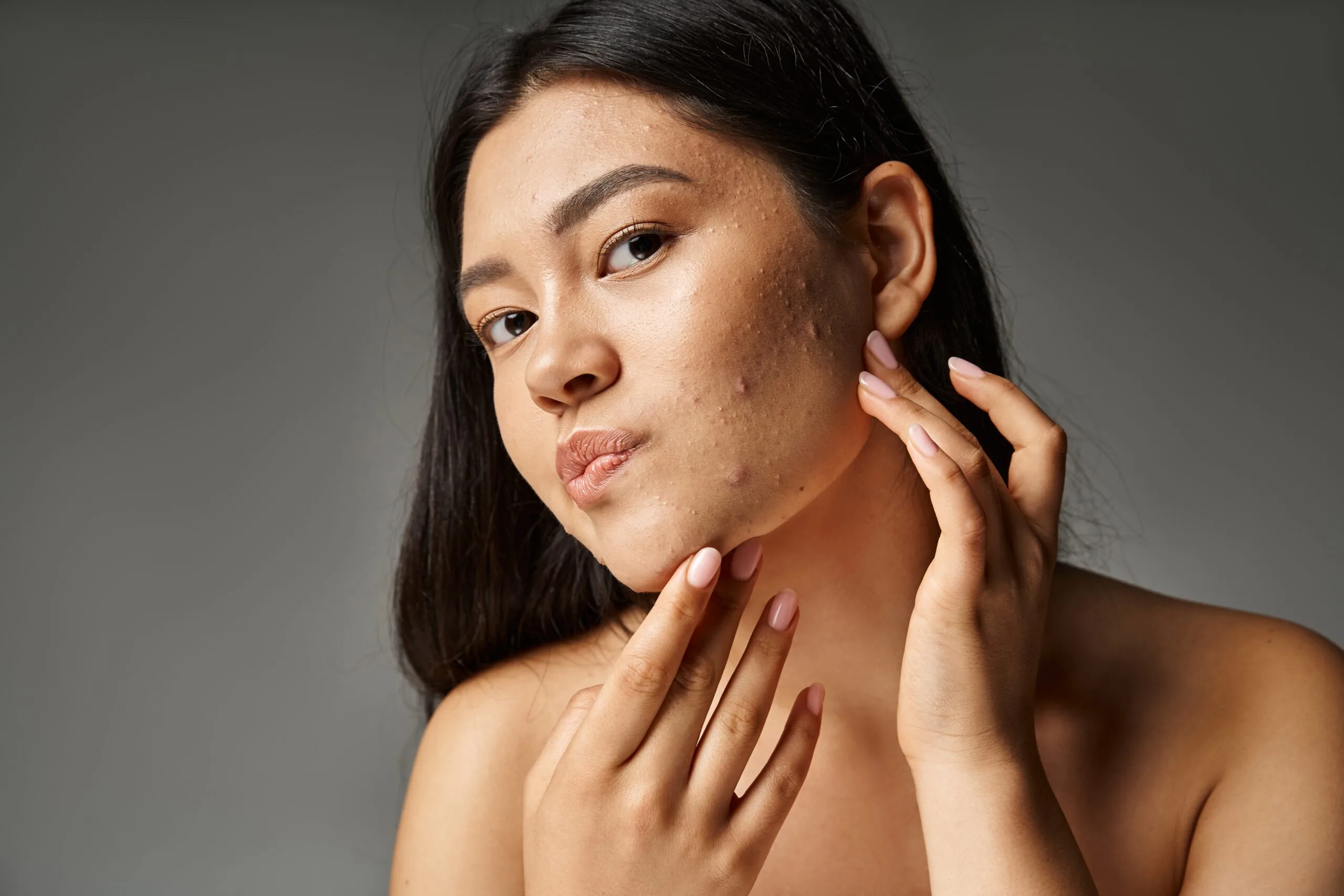 Woman with acne-prone skin touching her cheek against a neutral background