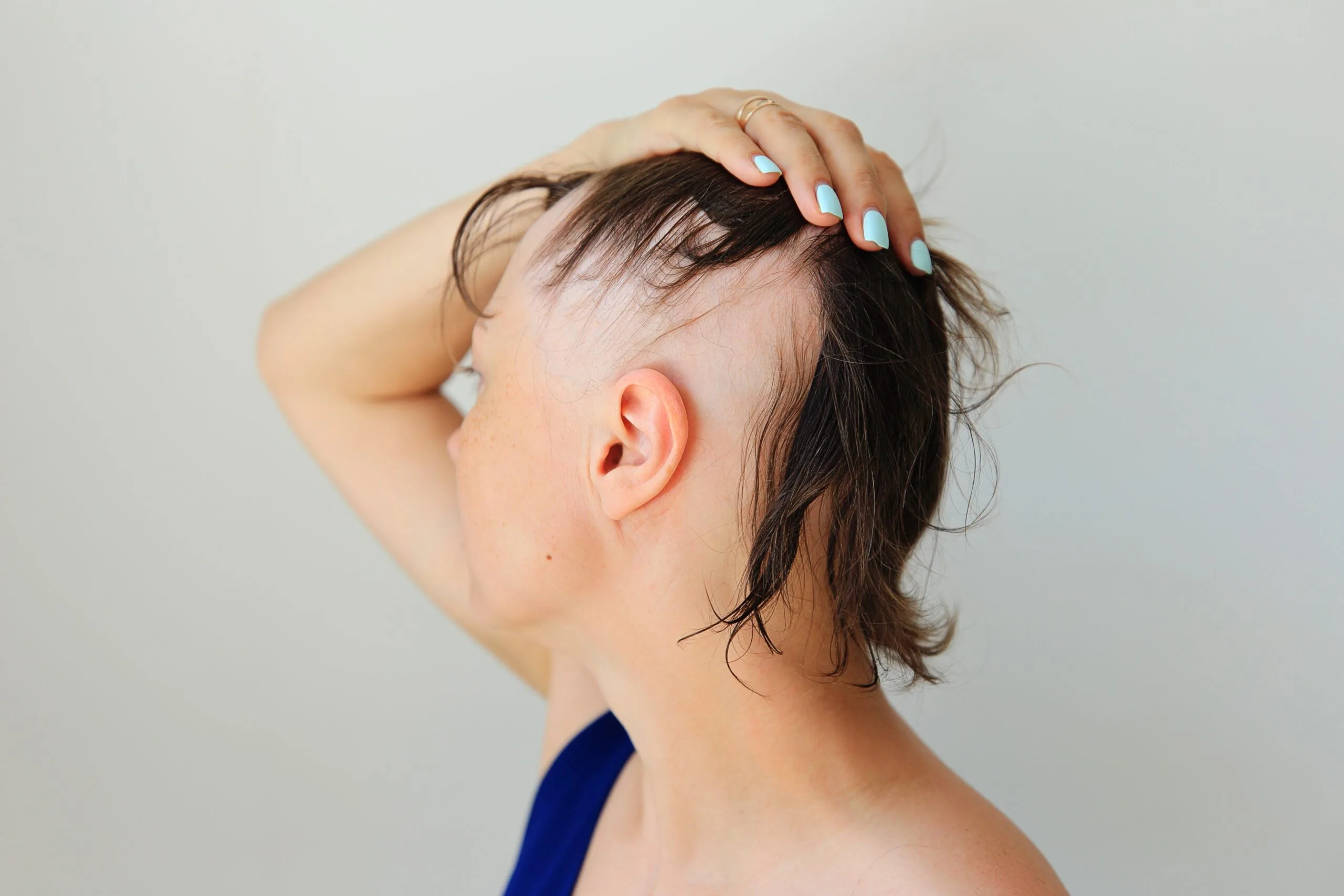 Person showing scalp with patchy hair loss characteristic of alopecia areata