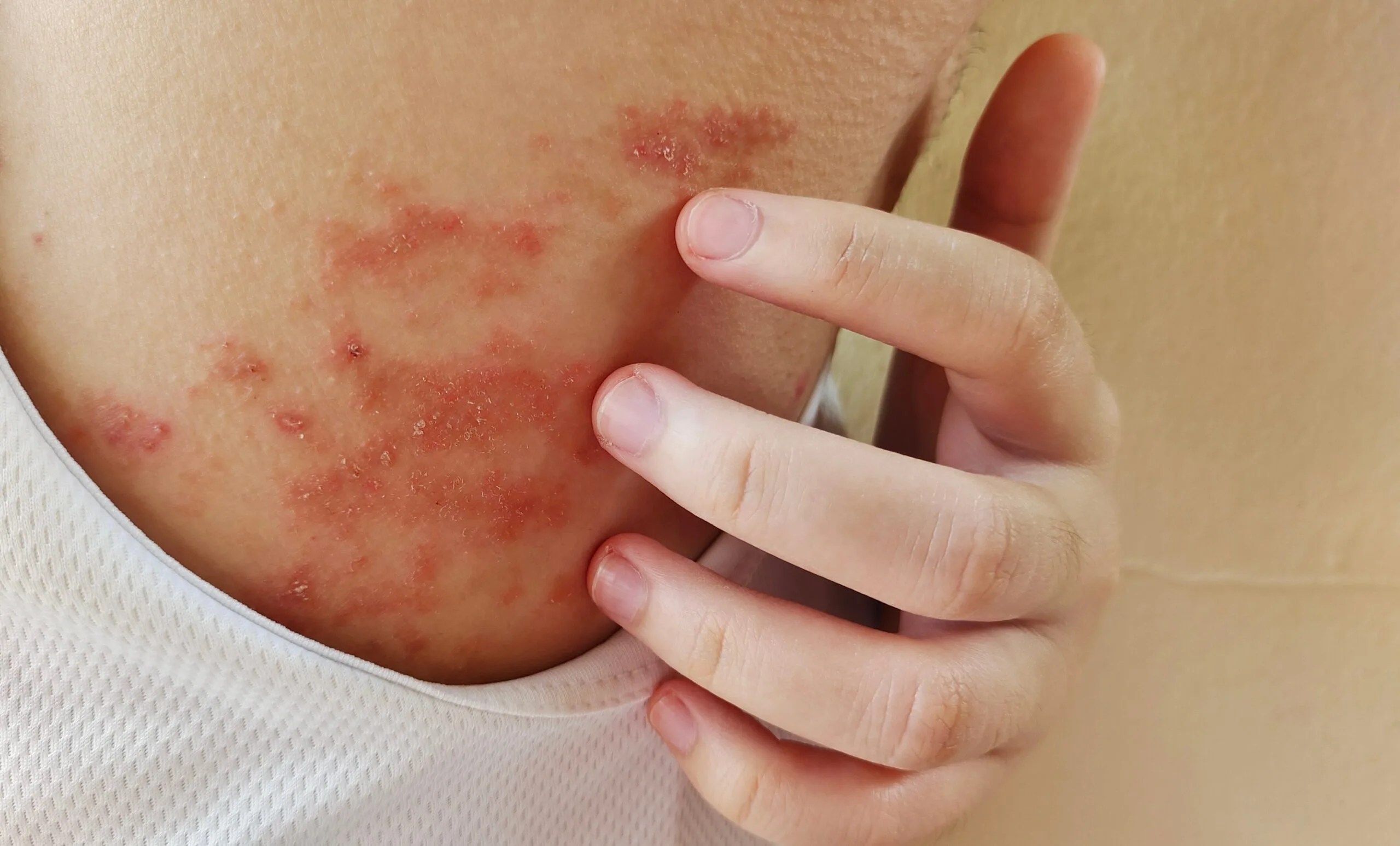 Close-up of a patient's shoulder showing red, inflamed patches of atopic dermatitis with visible irritation and scaling