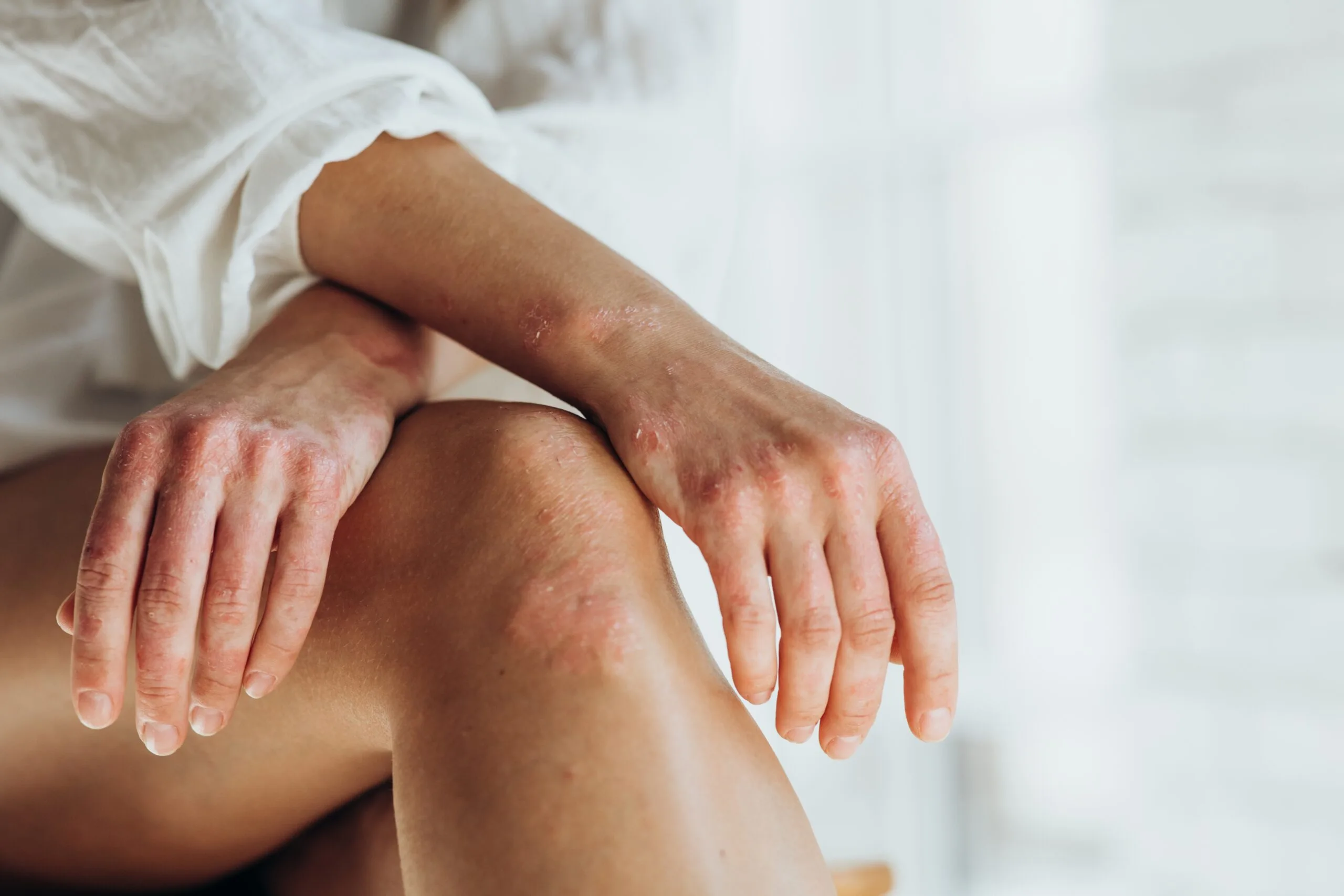 Person's hands resting on their arm, showing reddened, inflamed skin patches characteristic of autoimmune skin conditions