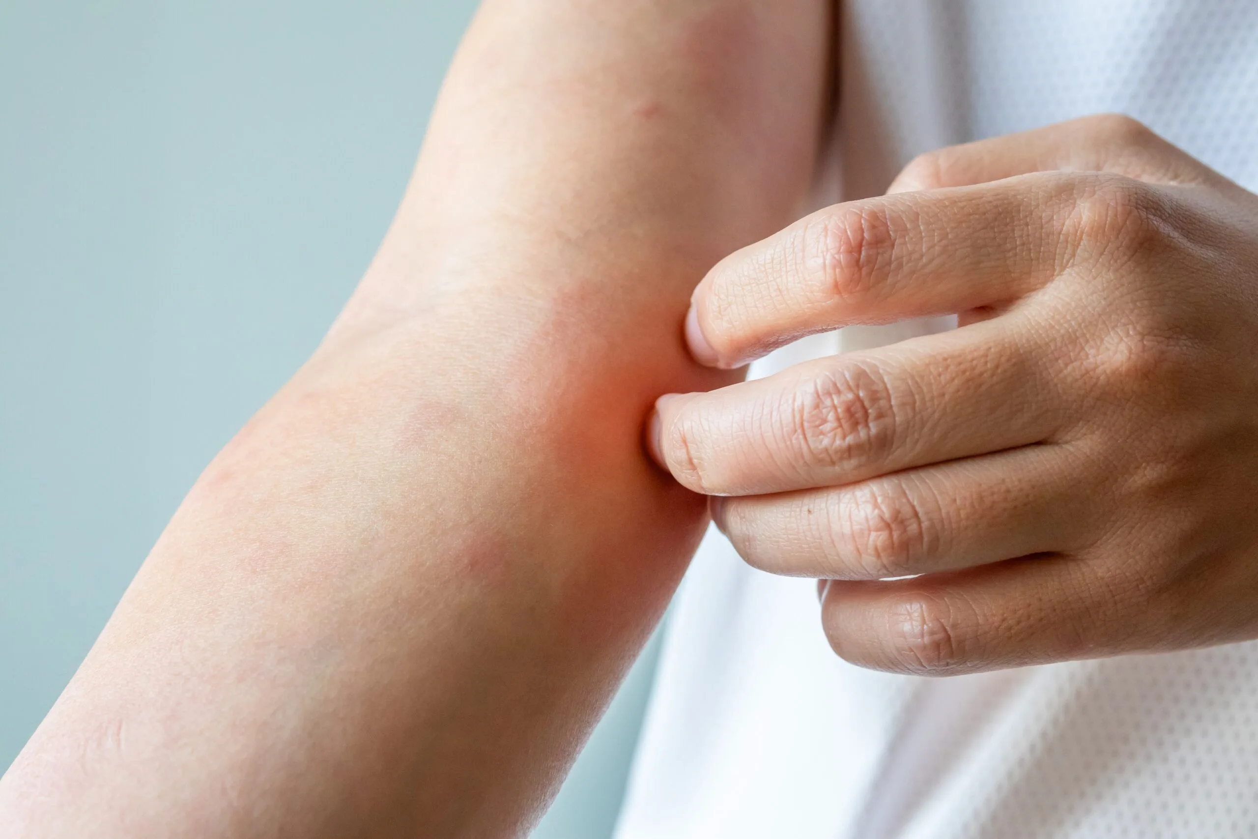 Person scratching red, irritated skin on their arm showing eczema inflammation