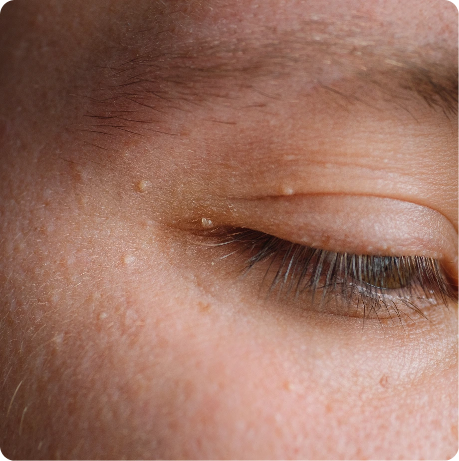 Closeup of closed eye showing fine lines and brown spots on eyelid and surrounding skin