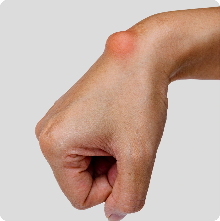 Hand with red cyst or bump on the knuckle area